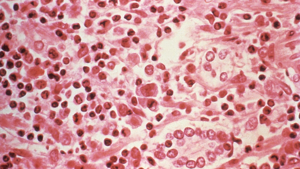 This undated photo shows a micrographic study of liver tissue seen from a Hantavirus pulmonary syndrome (HPS) patient. (Reuters Photo)