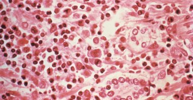 This undated photo shows a micrographic study of liver tissue seen from a Hantavirus pulmonary syndrome (HPS) patient. (Reuters Photo)