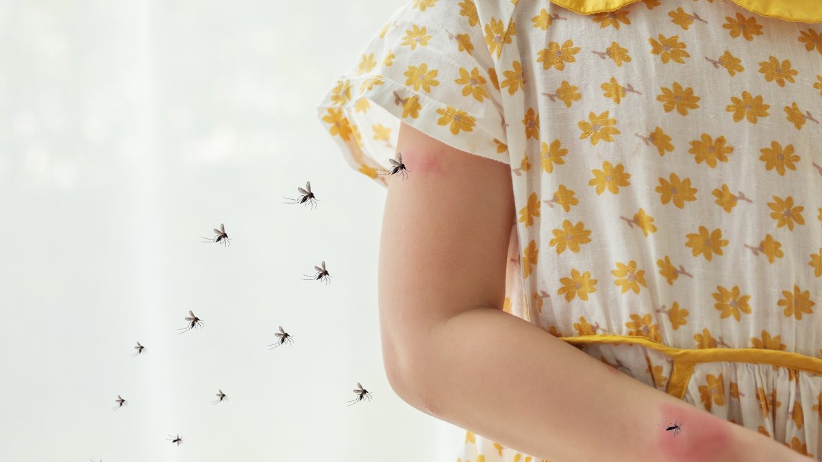 A young girl is riddled with mosquito bites. (Shutterstock Photo)