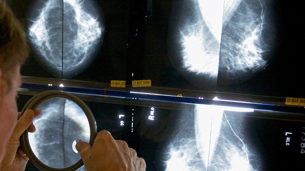 A radiologist uses a magnifying glass to examine mammograms for breast cancer, Los Angeles, U.S., May 6, 2010. (AP Photo)