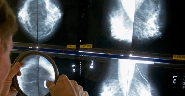 A radiologist uses a magnifying glass to examine mammograms for breast cancer, Los Angeles, U.S., May 6, 2010. (AP Photo)