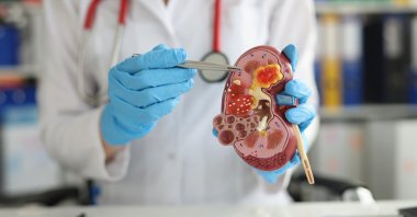 A doctor uses an anatomical kidney model to explain kidney diseases, treatments and diagnostics. (Shutterstock Photo)