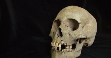 This 2006 image from Angela Lieverse shows the skull of a young girl who was buried with victims of the plague in Siberia.  (Angela Lieverse via AP)