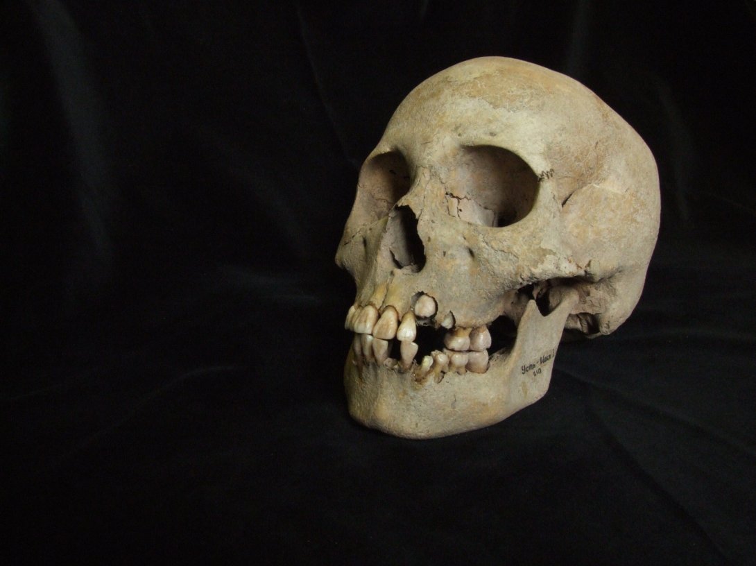 This 2006 image from Angela Lieverse shows the skull of a young girl who was buried with victims of the plague in Siberia.  (Angela Lieverse via AP)