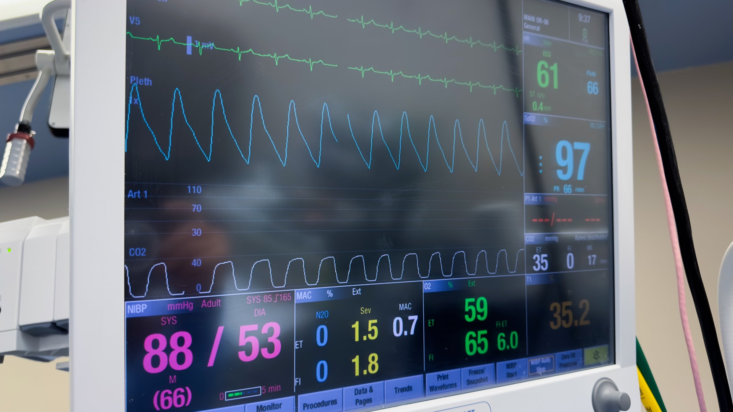A hospital monitor tracks a patient's heart rate and vital signs during treatment. (Shutterstock Photo) 