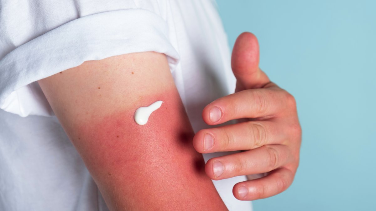 A man applies cream to a sunburn. (Shutterstock Photo)