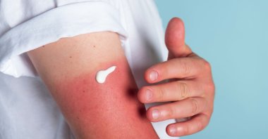 A man applies cream to a sunburn. (Shutterstock Photo)