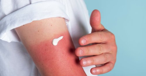 A man applies cream to a sunburn. (Shutterstock Photo)