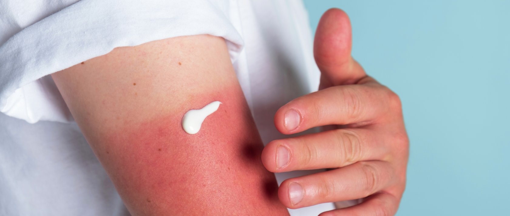 A man applies cream to a sunburn. (Shutterstock Photo)