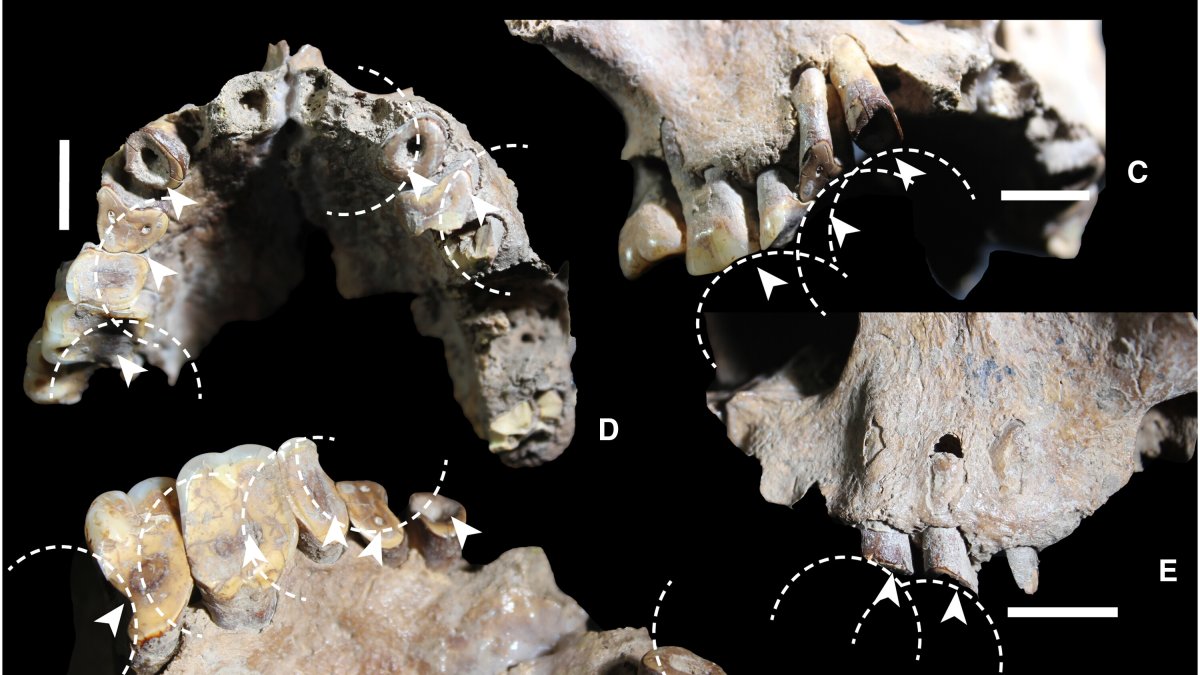  Drug use-related dental wear in early Sulawesi foragers, in this undated file photo published as part of research. (Science Advances Journal Handout) 