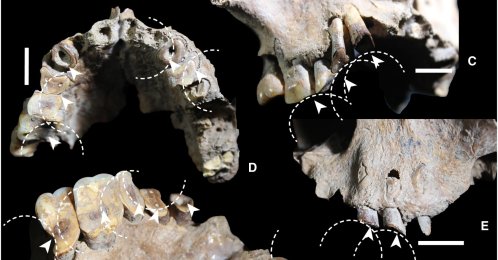  Drug use-related dental wear in early Sulawesi foragers, in this undated file photo published as part of research. (Science Advances Journal Handout) 