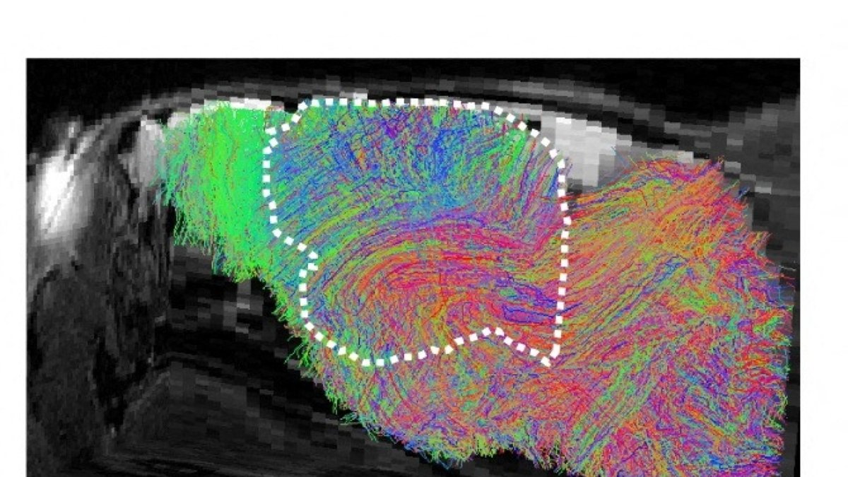 Human brain tissue grows in mice in study of related disorders