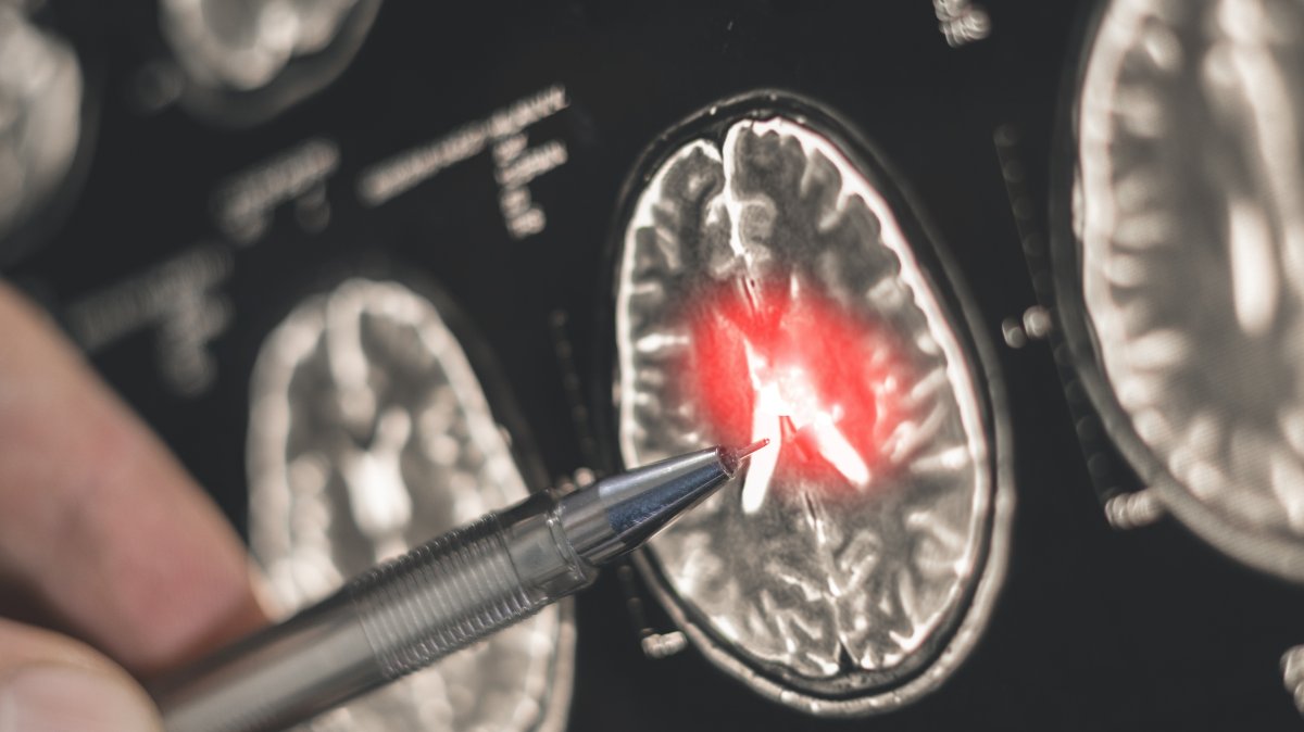 A doctor examines a brain scan. (Shutterstock Photo)