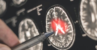 A doctor examines a brain scan. (Shutterstock Photo)