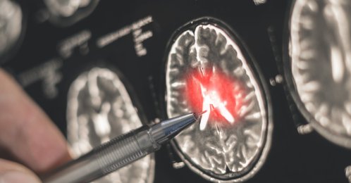 A doctor examines a brain scan. (Shutterstock Photo)